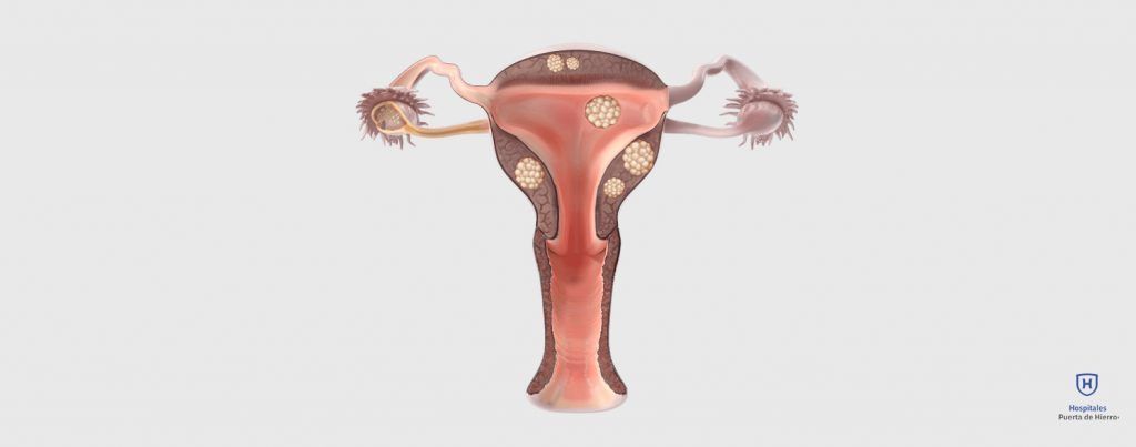 Tipos de miomas uterinos